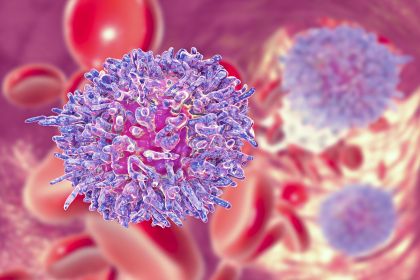leucemia mieloide acuta: un trial clinico con CAR-T