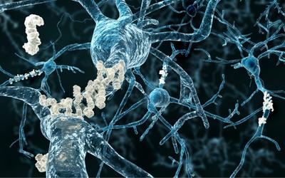 Neuroni con placche amiloidi